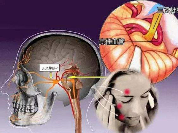 三叉神经痛